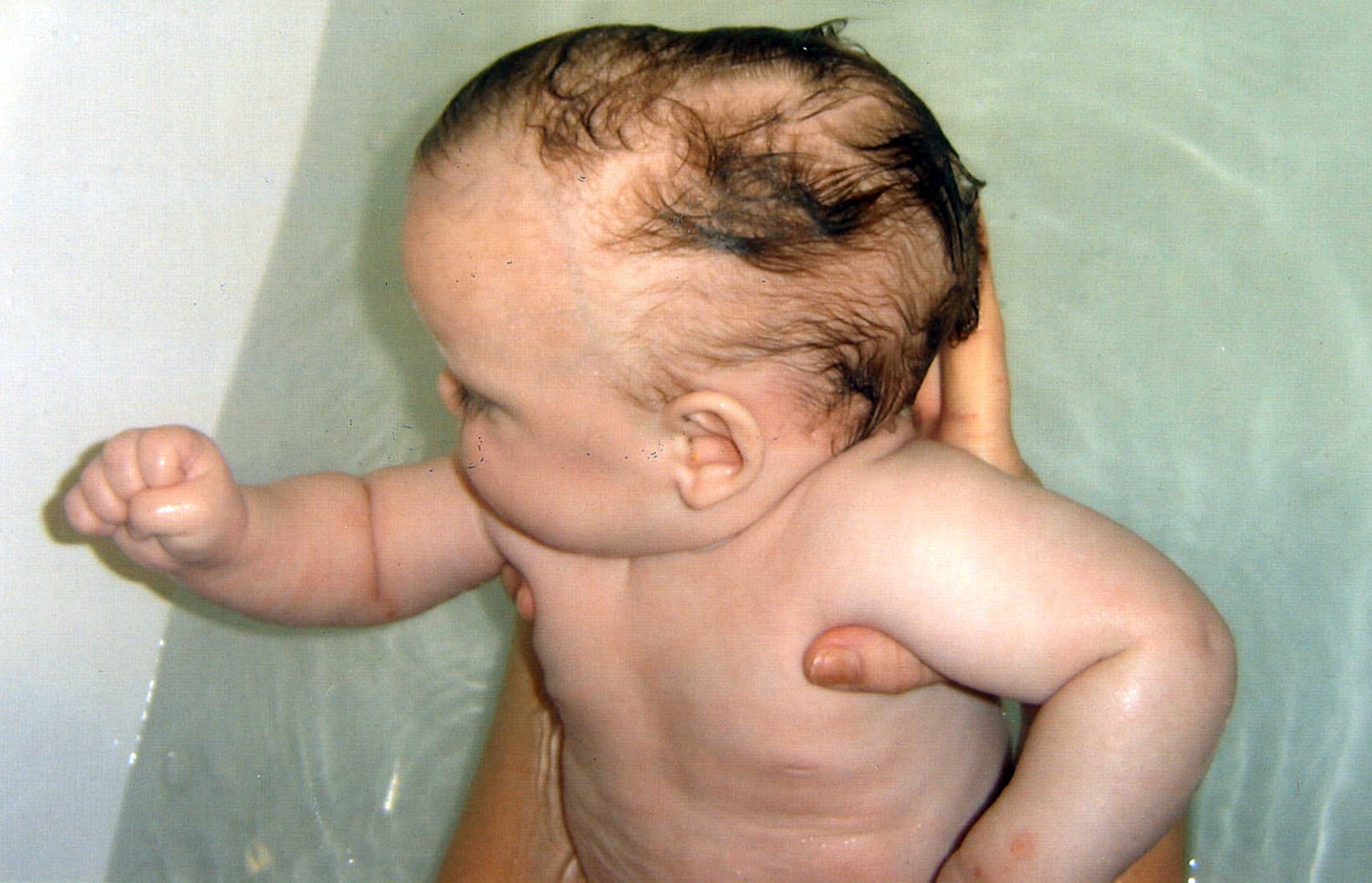 Brave baby born with irregular shaped head